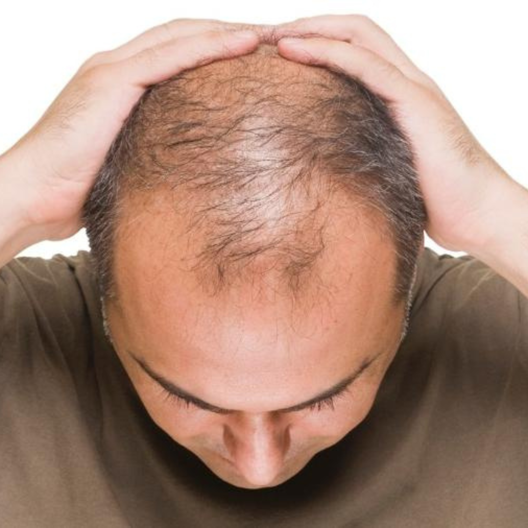 Calvície Masculina